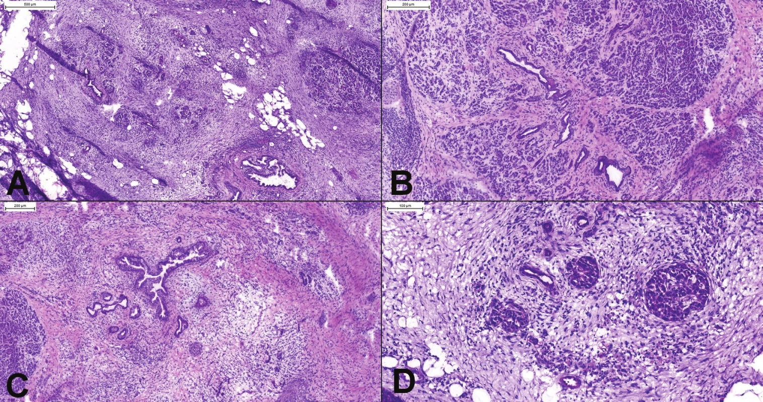 (A) Chronická pankreatitída. Aj v oblastiach ťažkej atrofie (vľavo hore) je stále viditeľné organoidné lobulárne usporiadanie.
(B) Oblasť s miernou až stredne výzaznou atrofiou a fibrózou. Je prítomná proliferácia duktov, ktoré sú však lokalizované
v centre pankreatického acinu. (C) Ťažká atrofia (acinárne štruktúry úplne chýbajú) s proliferáciou duktov s hyperplastickým
epitelom. Lobulárne usporiadanie je známkou pankreatitídy, nejedná sa o karcinóm. (D) Psudohyperplastické Langerhansove
ostrovčeky a proliferujúce dukty s reaktívnymi atypiami môžu imitovať karcinóm v dezmoplastickej stróme.