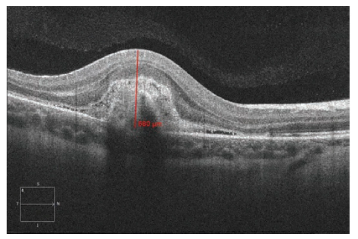 Spektrální HD OCT: Lineární horizontální transfoveolární
sken OD. Výrazné ztluštění a zvýšení objemu makulární oblasti
s patrným středně hyperreflektivním ložiskem aktivní CNV, kolem
ložiska plochá serózní ablace smyslového epitelu. Tloušťka juxtafoveolární
oblasti 680 μm v době stanovení diagnózy