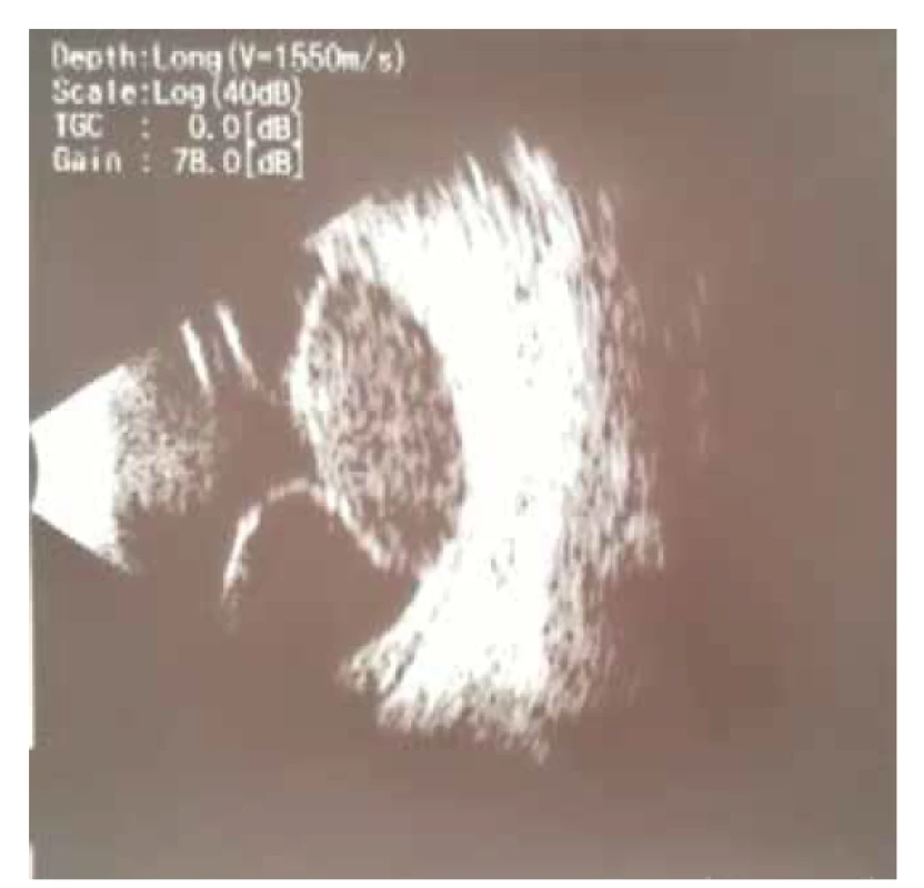 Ultrazvuk pravého bulbu – téměř totální amoce (mimo
malého okrsku nahoře), v temporální periferii solidní ložisko s hladkým
povrchem s nízkou vnitřní reflektivitou