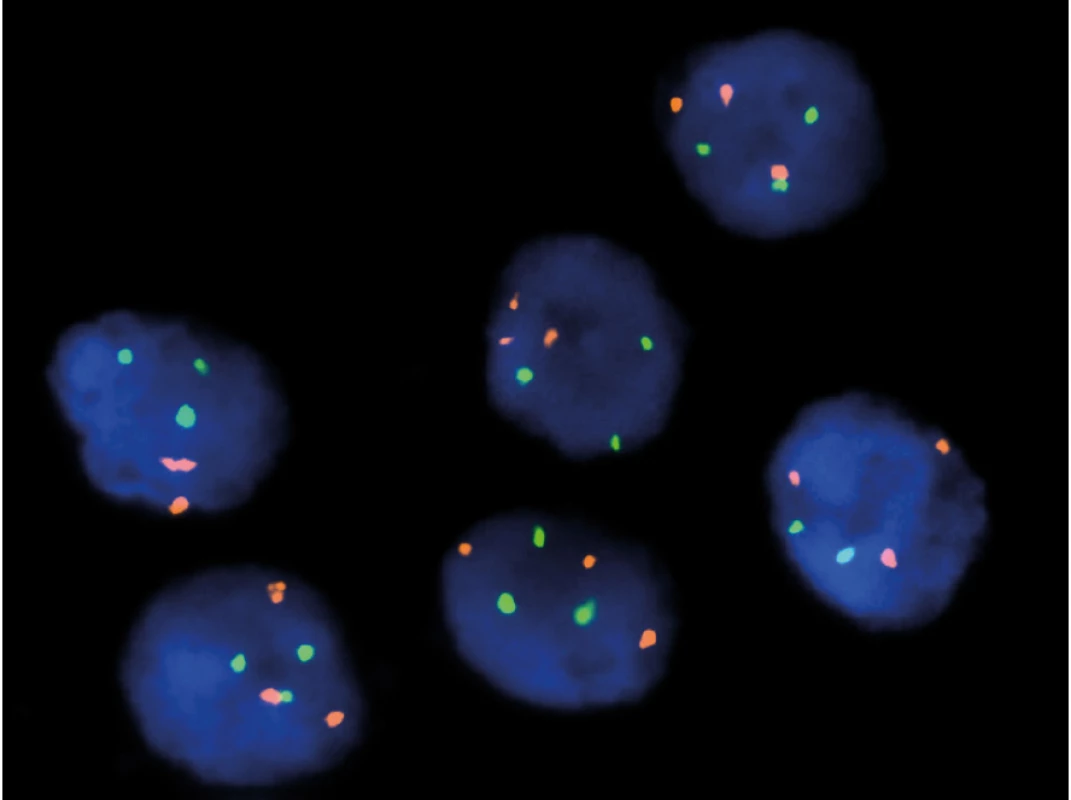FISH – 7/17 trisomie u papilárního renálního
karcinomu, typ 1<br>
Fig. 1. FISH – 7/17 trisomy in papillary renal cell
carcinoma, type 1