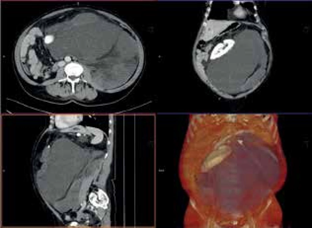 CTA obraz tumoru <br>
Fig. 6: CTA scan of the tumor