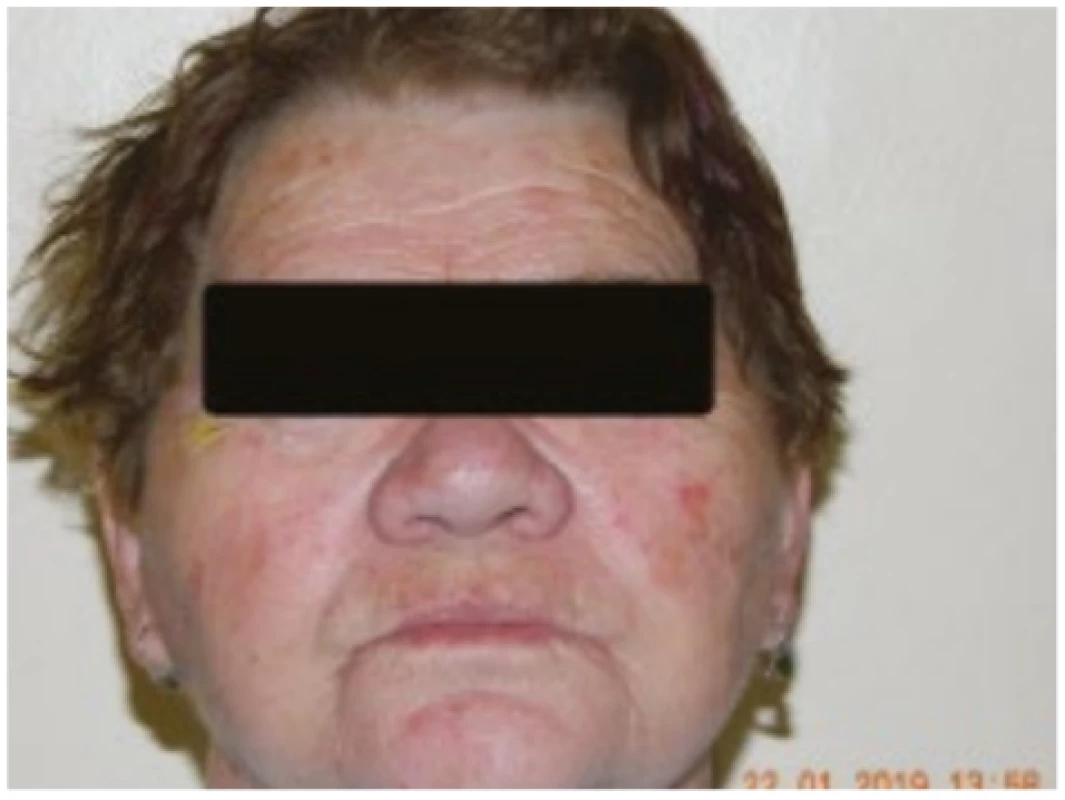 Face of patient from case report 2 with long-term
well treated facial rosacea, with isolated actinic keratoses 