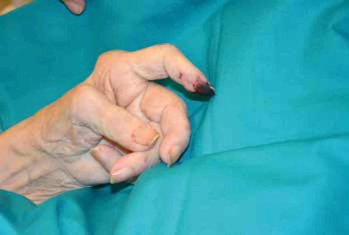 Gangréna distálního článku prstu při revmatoidní vaskulitidě.