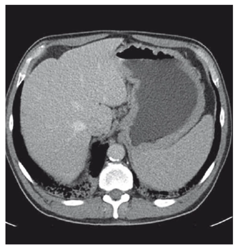 CT obraz zesílené stěny žaludku, hepatosplenomegálie,
abdominální lymfadenopatie, transverzální řez.<br>
Fig. 2. CT scan of thick gastric wall, hepatosplenomegaly,
abdominal lymphadenopathy, transversal