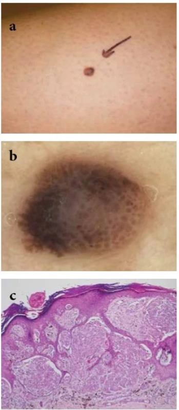  a-c. Maligní melanom se spitzoidními rysy u dospělé
pacientky