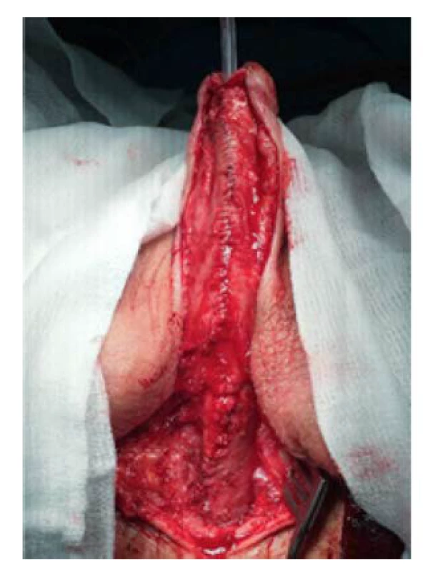 Kompletní tubulizace uretry
v rámci druhé doby uretroplastiky<br>
Fig. 6. Complete urethral tubulization
during second stage of urethroplasty