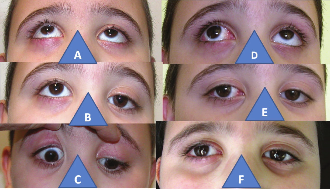 6-year-old boy with congenital palsy of the inferior rectus muscle in the right eye: increase of elevation in right eye (A), hypertropia in right eye (B), incapacity of depression in right eye (C), practically aligned elevation after surgery with subsequent V-syndrome (D), practically parallel positioning of eyes after surgery (E), finding is identical also three years after surgery (F)
