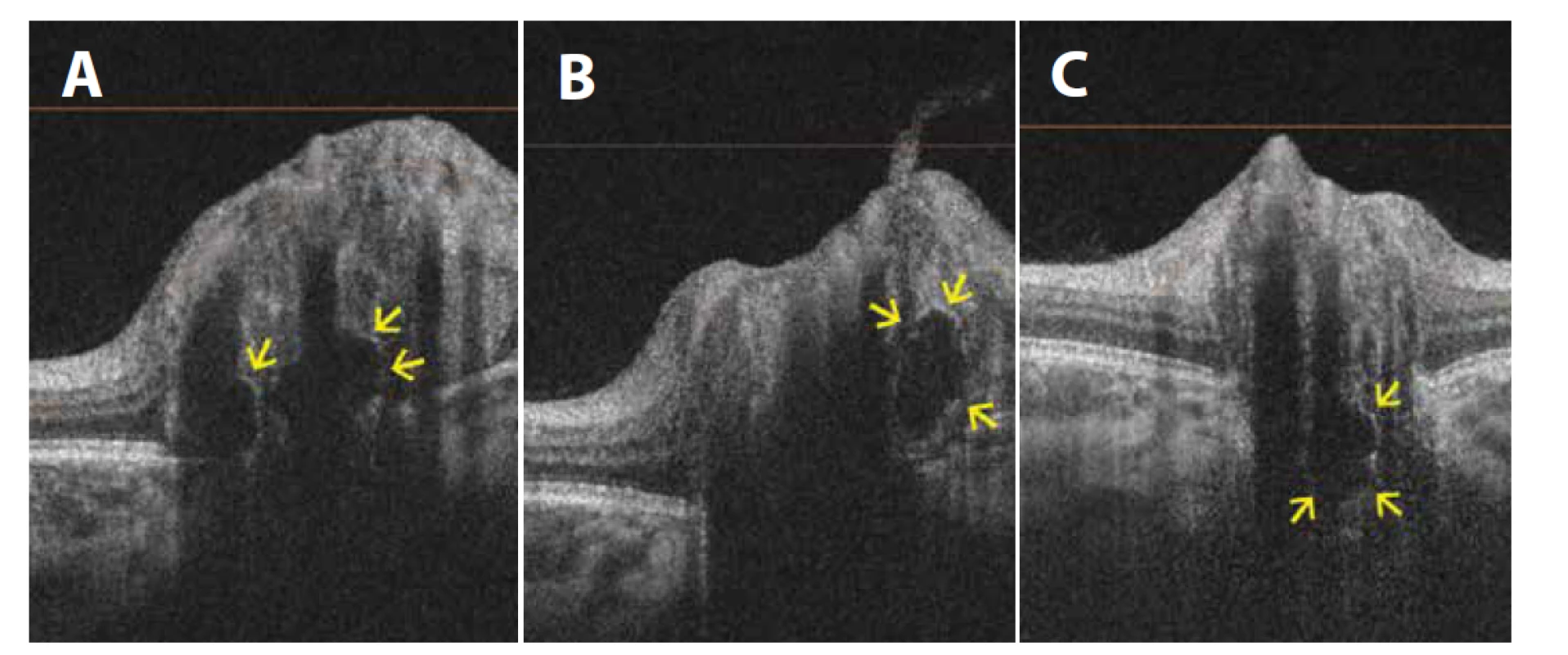 Lineární horizontální transpapilární swept source OCT skeny zobrazují v různých řezech drúzy terče zrakového nervu jako hyporeflektivní
ložiska s hyperreflektivním lemem<br>
(A) Dvě hluboké drúzy a elevace terče zrakového nervu u 11leté pacientky. (B) Další drúza na stejném oku, ale na jiném řezu. (C) Hluboká
drúza u 5letého pacienta