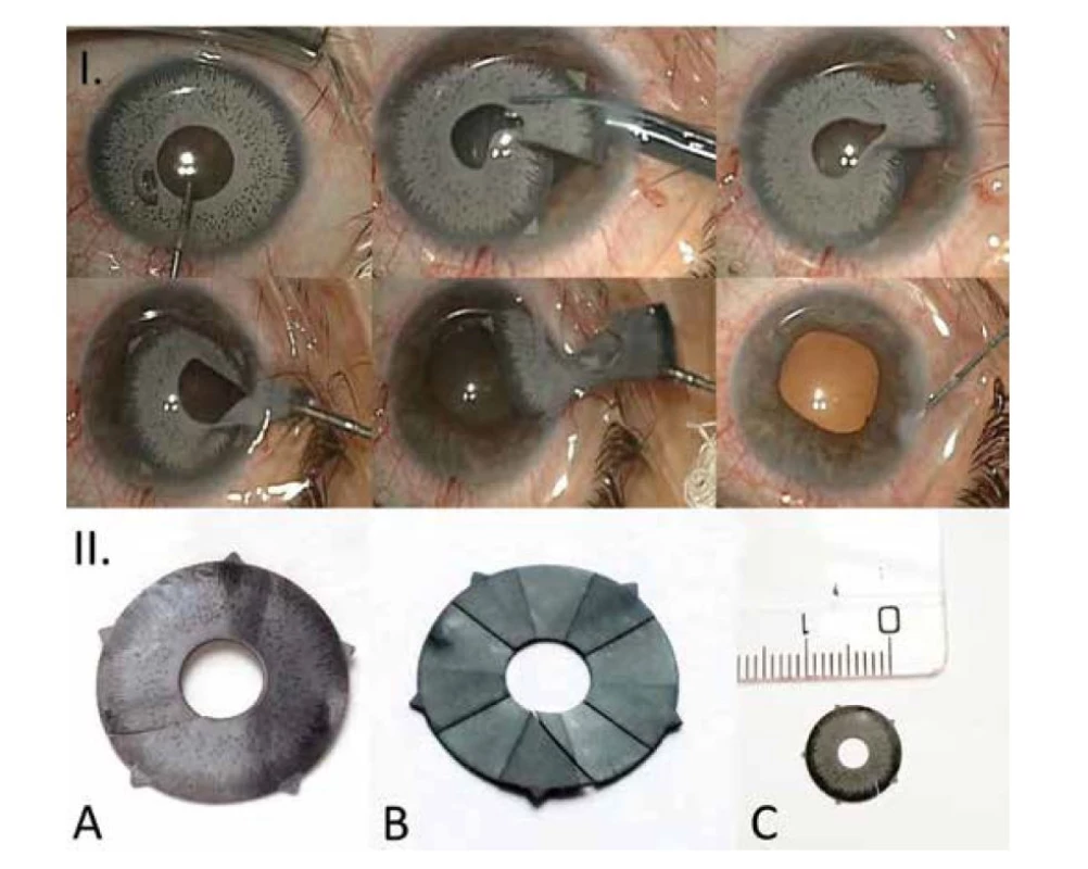 Explantace arteficiální kosmetické duhovky pravého oka (I.) a obrázek arteficiálního
kosmetického duhovkového implantátu po explantaci (II.): přední strana (A), zadní strana (B) a velikost
implantátu (C)
