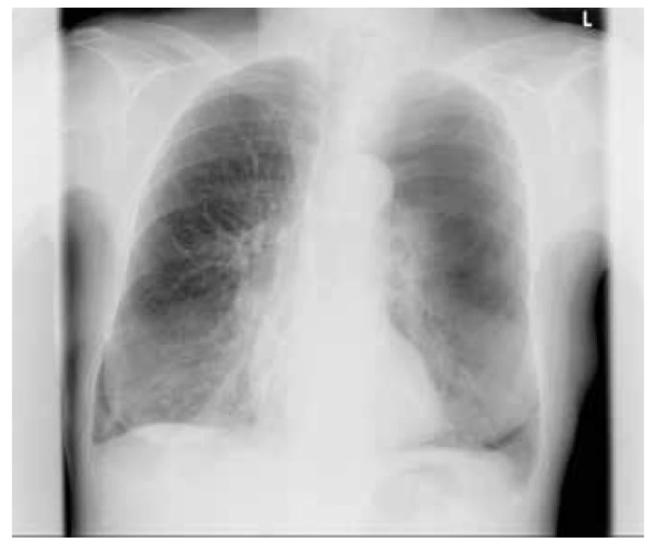 Zadopřední skiagram hrudníku – v levém plicním poli je viditelná
linie, od které do vrcholu a laterálně není patrná plicní kresba – obraz
pneumotoraxu l. sin