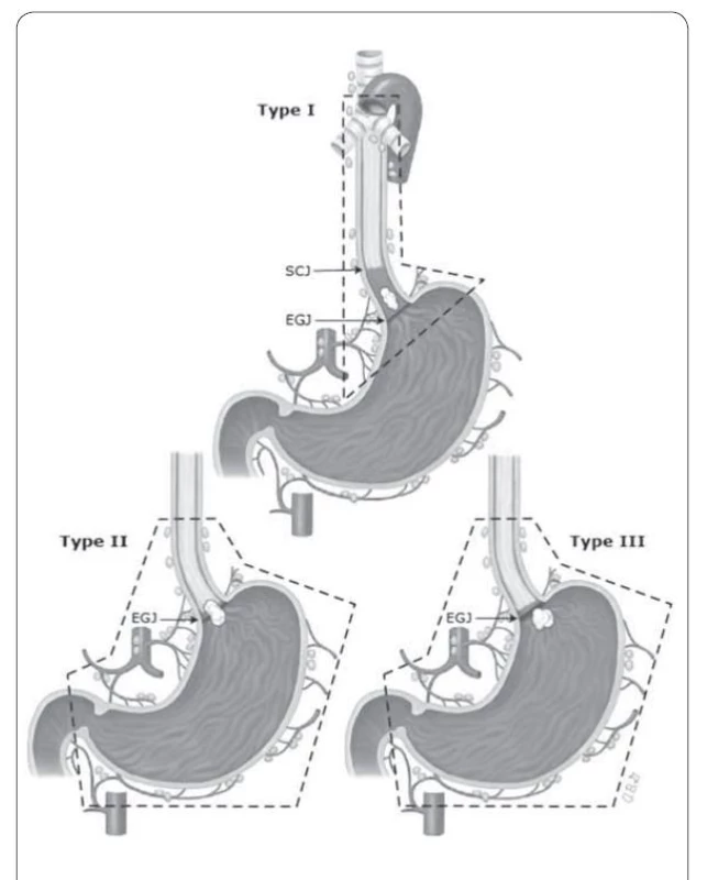 Znázornění rozsahu resekce a lymfadenektomie u nádorového
nemocnění gastroezofageální junkce. Rozdělení dle Siewertovy klasifi kace.
Převzato z [2].