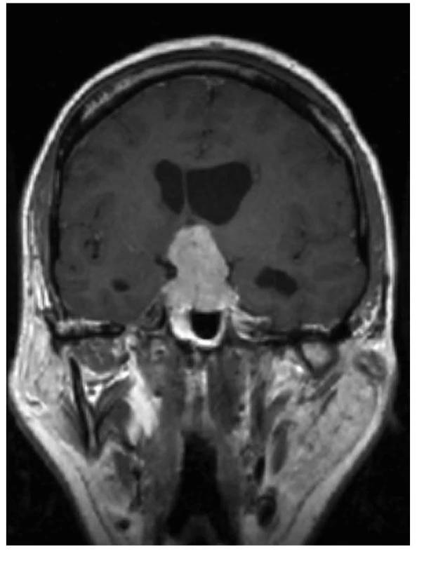 MR obraz makroadenomu hypofýzy (archiv autora
a Radiodiagnostické kliniky Všeobecné fakultní nemocnice a 1. LF UK v Praze)