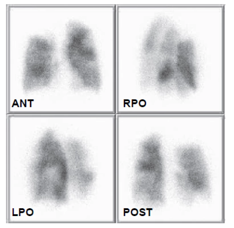 Recentní scintigrafie plicní perfuze 26. 4. 2010. Jsou patrné
vícečetné segmentární defekty perfuze v obou plicních křídlech.
Vzhledem ke zhruba dvouměsíční anamnéze dušnosti již není ohraničení
defektů příliš ostré, nicméně interpretace je jednoznačná.
