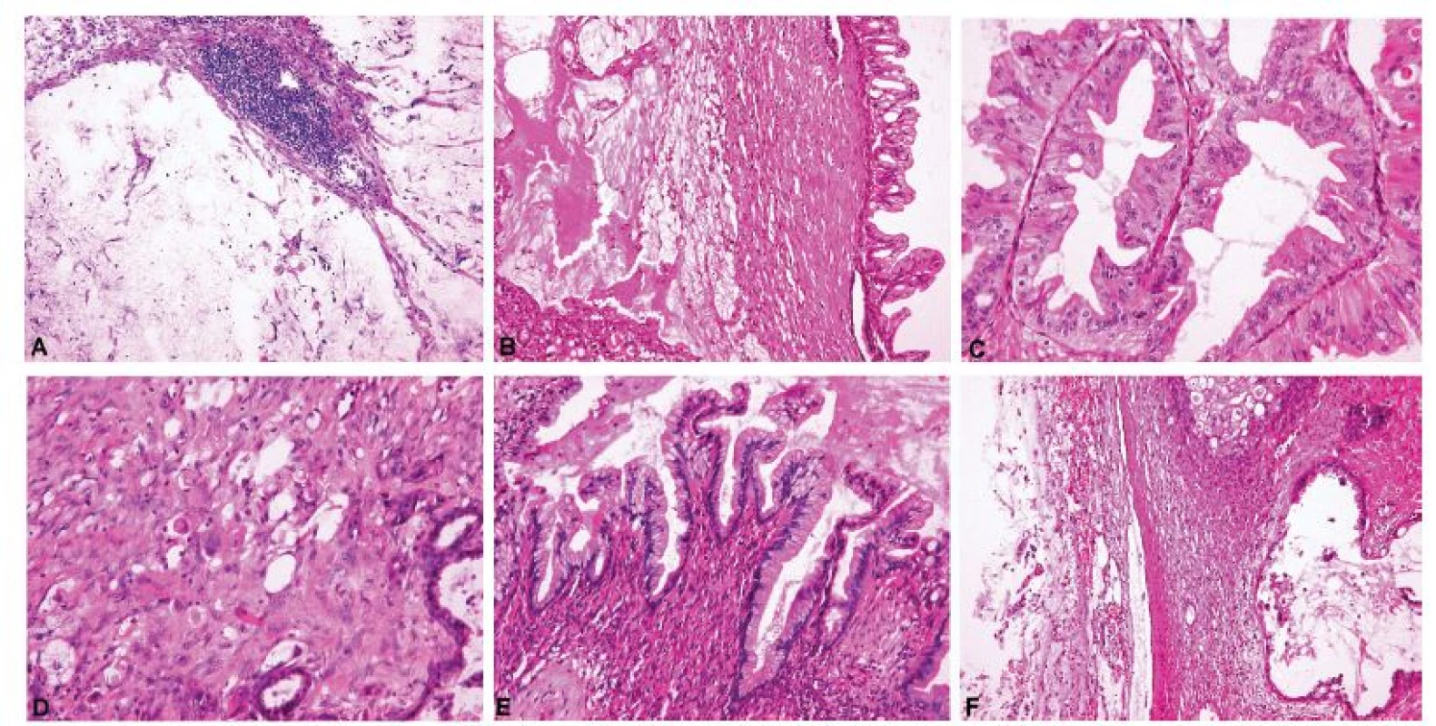 Metastatický adenokarcinom pankreatu demonstrující znaky typické pro metastázy mucinózních adenokarcinomů do ovaria.<br>
A – acelulární stromální jezírka hlenu v ovariu (pseudomyxoma ovarii), shodný nález ve dvou peroperačně vyšetřených tkáňových blocích (peroperačně hlášeno
jako diseminace extraovariálního mucinózního nádoru) (peroperační vyšetření, HE, 100x); B – acelulární stromální jezírka hlenu v blízkosti nádorového
proliferujího mucinózního epitelu (definitivní vyšetření, HE, 100x); C – cystopapilární komponenta nádoru mimikující mucinózní borderline nádor ovaria (paradoxní
maturace) (definitivní vyšetření, HE, 200x); D – disociace nádorových buněk do stromatu (definitivní vyšetření, HE, 200x); E – cystopapilární komponenta
nádoru mimikující mucinózní cystadenom ovaria (paradoxní maturace) (definitivní vyšetření, HE, 200x); F – acelulární depozita hlenu na povrchu ovaria (pseudomyxoma
ovarii) (definitivní vyšetření, HE, 100x)