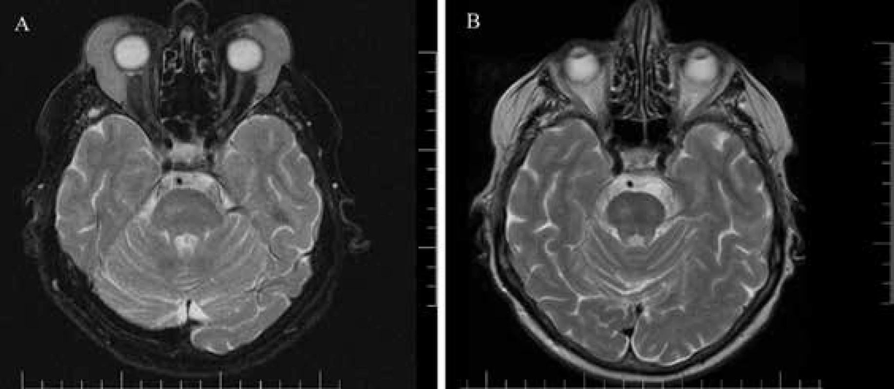 Pacient 1 - magnetická rezonancia hlavy: axiálny rez, T2 váženie, bilaterálny lymfóm horných mihalníc<br> A) v čase diagnostiky 02/2018 <br>B) po chemoterapeutickej a imunologickej liečbe 01/2019