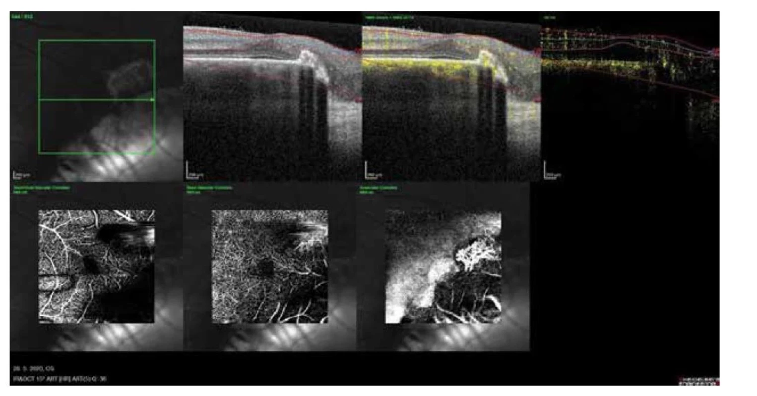 OCT – angiografia s neovaskulárnou membránou na okraji makuly (2020)