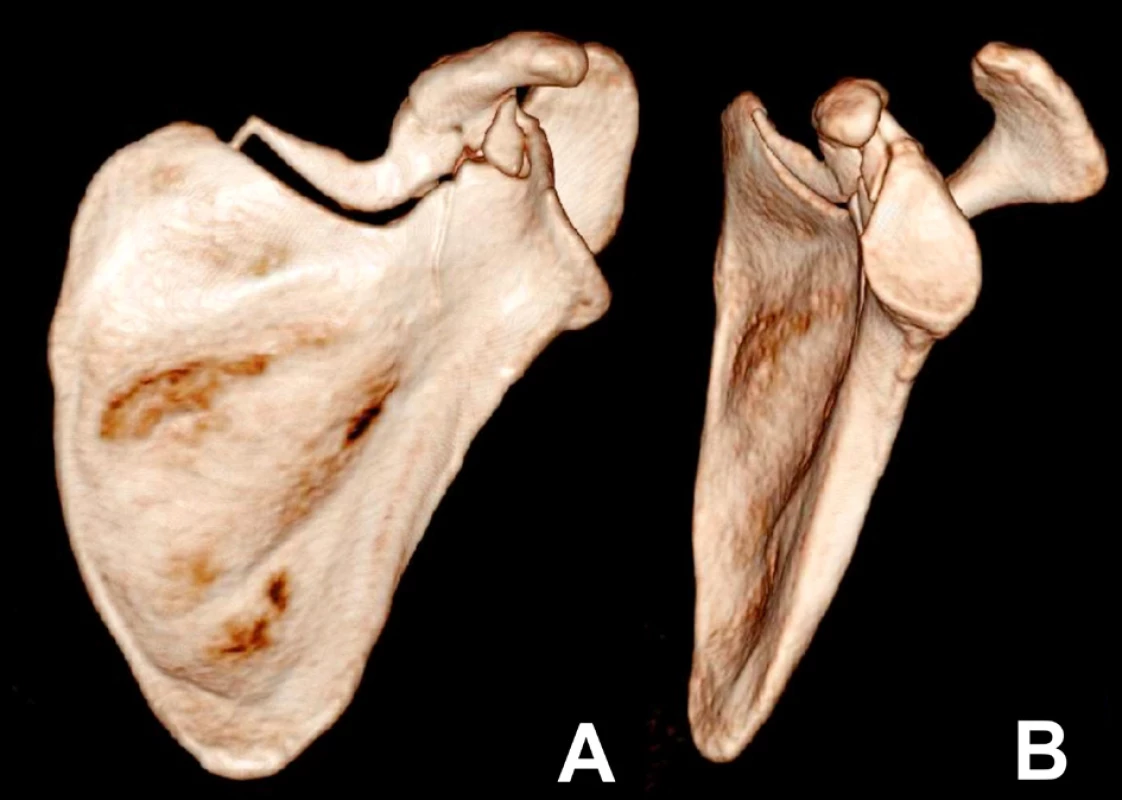 A+B – 3D CT reconstructions, anterior and lateral
views. The 3D CT reconstruction showed the fracture line
only partially, while it was well seen on 2D CT reconstructions