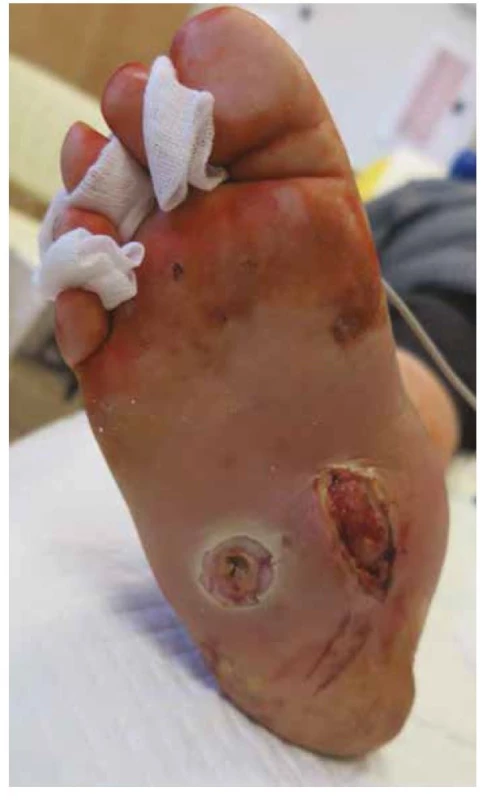Typický syndrom diabetické nohy: kombinace Charcotovy osteoarthropatie,
deformit, ulcerací a infekce