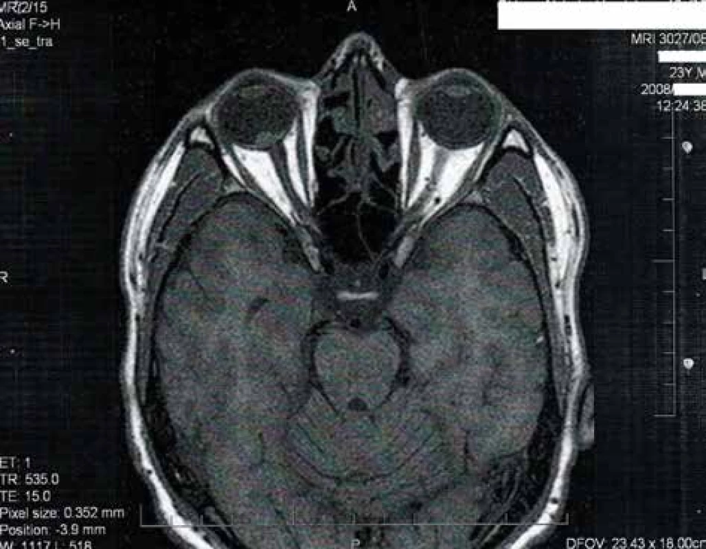 MRI image of tumour deposit close to disc of optic nerve in 2008