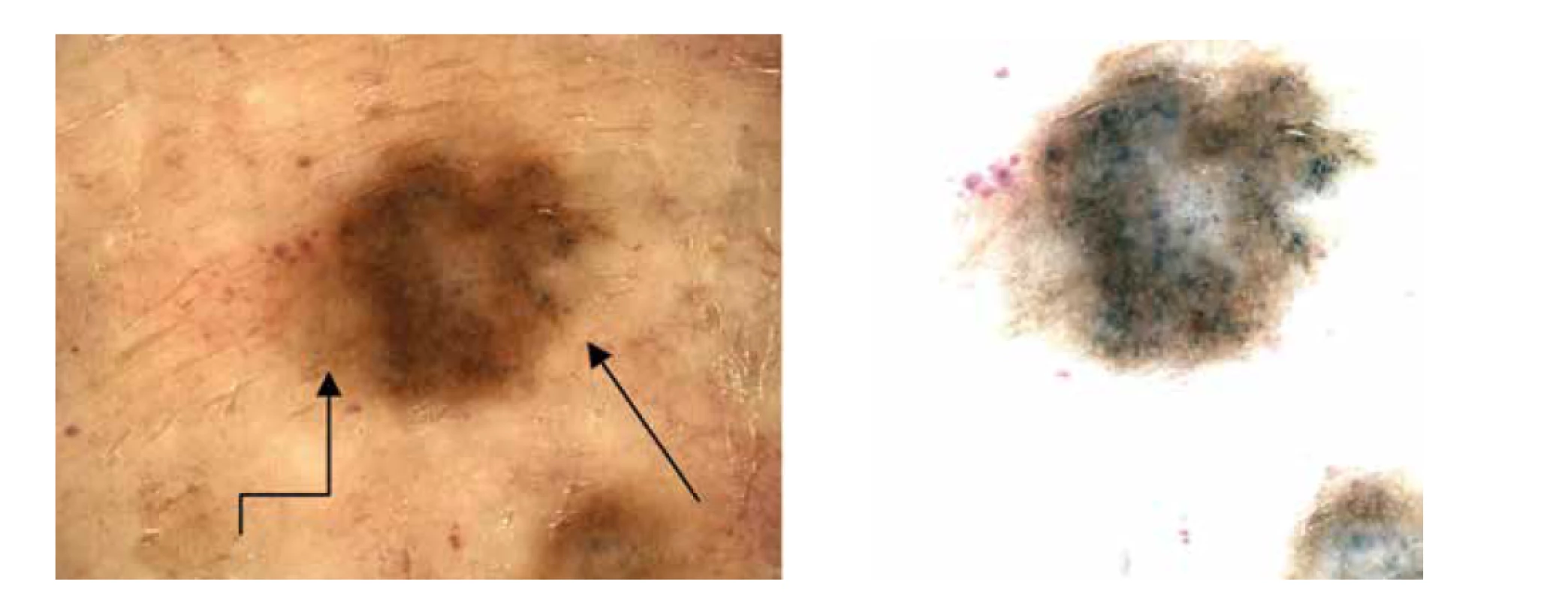 a,b. Dermatoskopicky heterogenní obraz – hnědé globule asymetricky, šedočerné tečky na pravém okraji (šipka),
diskrétní pigmentová síť na levém okraji (lomená šipka).