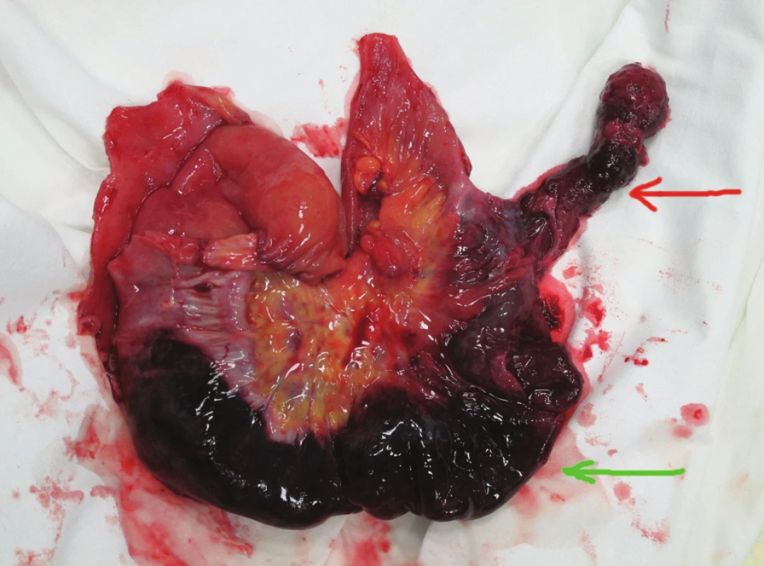Specimen of the small intestine
Hemorrhagic infarcted invagination (green arrow) with inverted
Meckel’s diverticulum (red arrow).