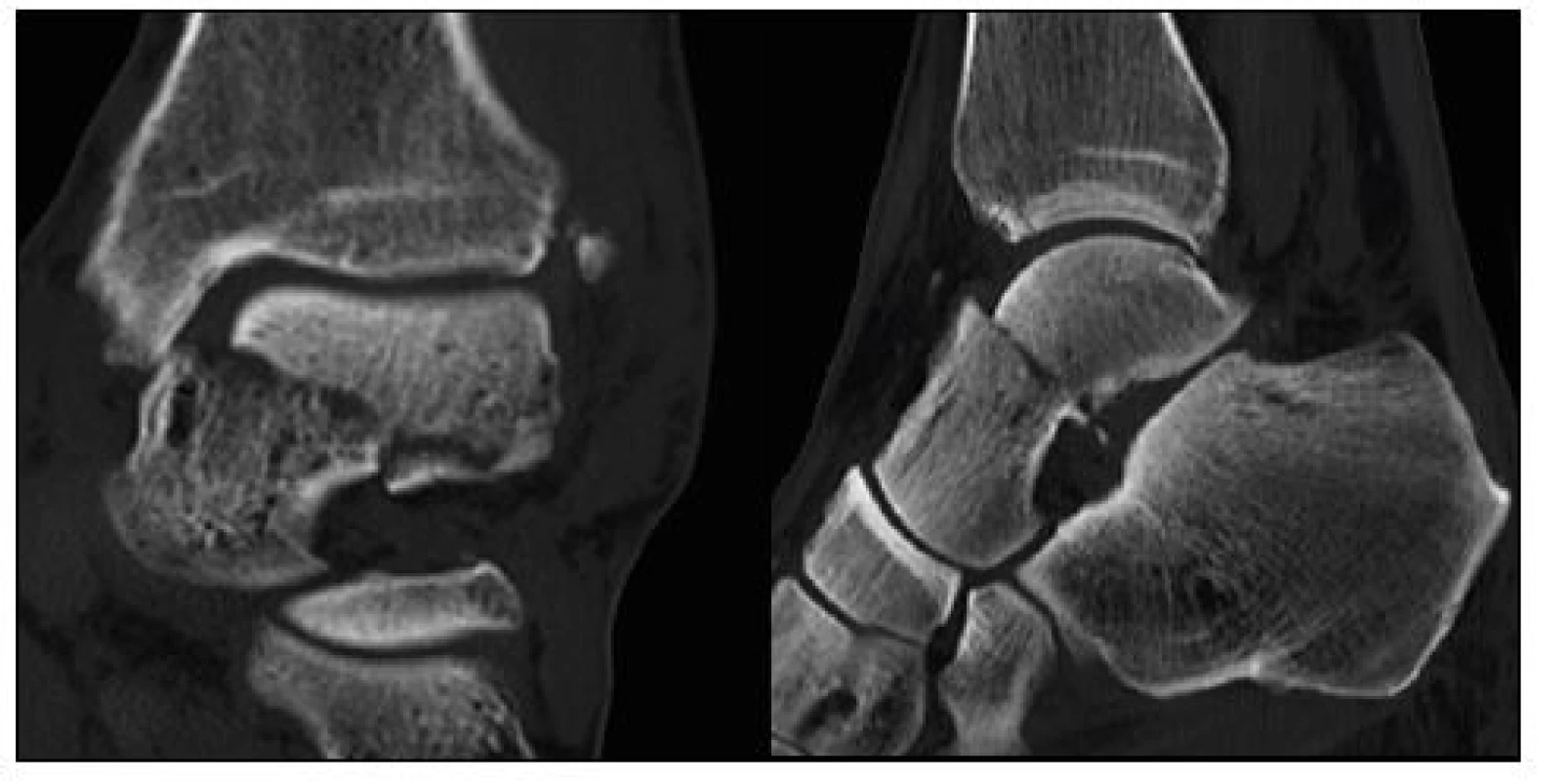 a,b: CT zlomeniny krčku talu – sagitální a koronární řezy