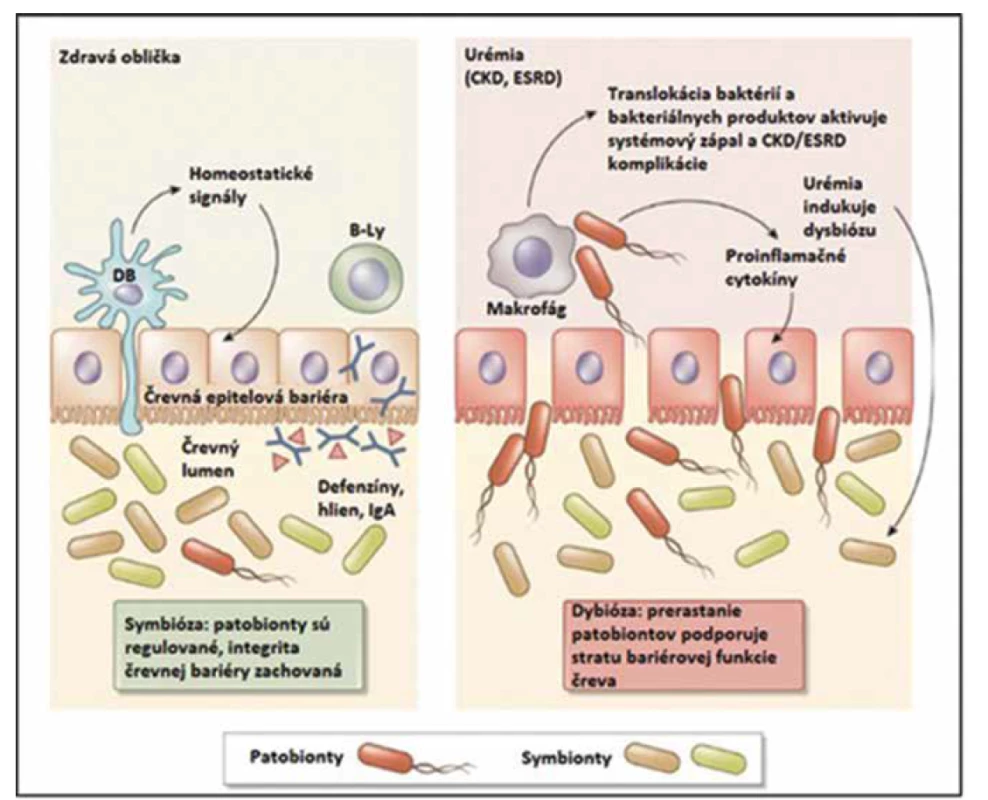 Koncept vzájomného vzťahu medzi zlyhávajúcimi obličkami a črevným mikrobiómom. Vľavo – Za fyziologických okolností
dominancia symbiotických baktérií, prítomnosť intaktnej črevnej bariéry, tvorba defenzínov, hlienu, integrita črevnej sliznice
a sekrécie imoglobulínu A (IgA) podporujú symbiózu medzi hostiteľským organizmom a jeho intestinálnym mikrobiómom. Intramurálna
imunita kontroluje prerastanie patobiontov v lumene gastrointestinálneho traktu. Vpravo – Metabolické zmeny asociované
s progresiou chronického obličkového zlyhávania do ESRD (end-stage renal disease) menia rovnováhu medzi symbiontmi
a patobiontmi v prospech prerastania patobiontov (dysbióza). Prerastanie patobiontov indukuje zápal a poškodenie bariérovej
funkcie čreva („leaky gut syndrome“), čím dochádza ku zvýšenému prestupu bakteriálnych komponentov a tiež živých baktérií
do vnútorného prostredia ľudského organizmu. Tento proces aktivuje imunitu charakterizovanú produkciou proinflamatórnych
cytokínov (systémový zápal) a modifikujú sa viaceré procesy počas chronického obličkového zlyhávania – progresia, akcelerovaná
aterogenéza a strata bielkovín (upravené podľa Anders a kol., 2013).<br>
Fig. 2. Concept of the mutual relationship between the failing kidneys and gut microbiome. Left – Under physiological circumstances
the dominance of symbiotic bacteria, presence of intact intestinal wall, defensins and mucus production, integrity of mucous
membranes and immunoglobulin A (IgA) secretion support the symbiosis between the host and its intestinal microbiome. The
intramural immunity controls the pathobiont overgrowth in the lumen of the gastrointestinal tract. Right – The metabolic changes
associated with CKD (chronic kidney disease) into ESRD (end-stage renal disease) change the equilibrium between the symbionts
and pathobionts in favor of the pathobionts (dysbiosis). The overgrowth of pathobionts induces inflammation and damage of
the intestinal barrier function („leaky gut syndrome“), which causes increased translocation of bacterial components and living
bacteria inside into the human organism. This proces activates the immunity characterised by proinflammatory cytokines production
(systemic inflammation) and modifies various processes during during CKD – its progression, accelerated atherogenesis and
protein loss (modified according to Anders et al., 2013).