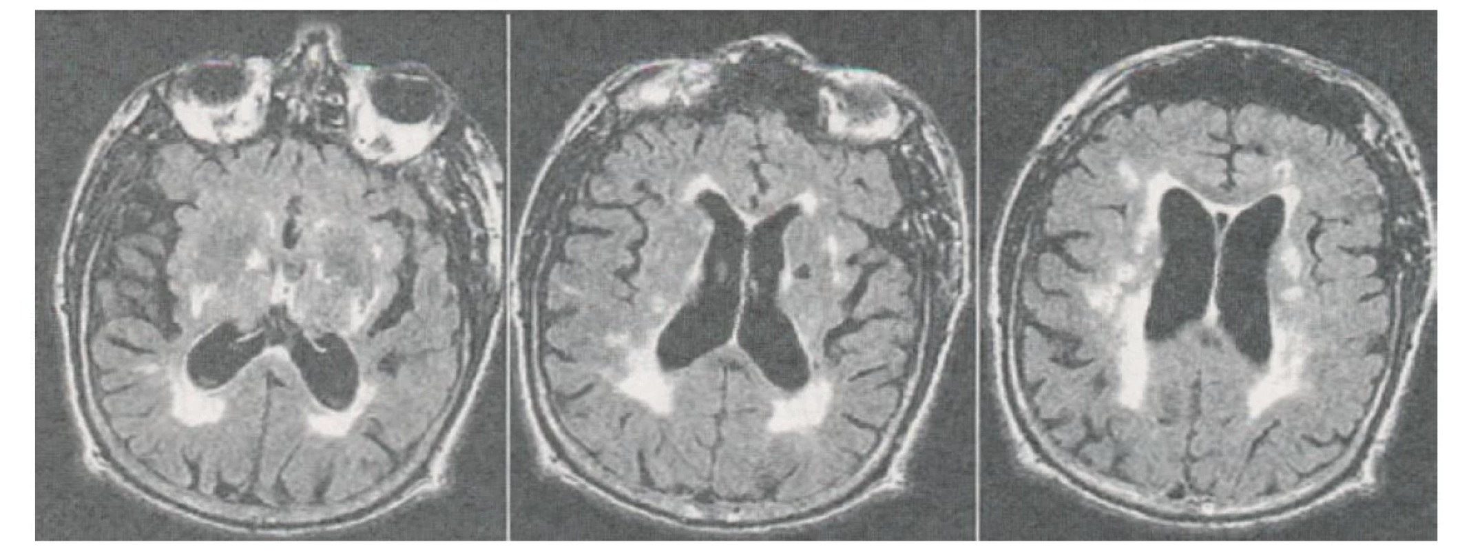 Zobrazení postupující atrofie hippocampu na MRI
