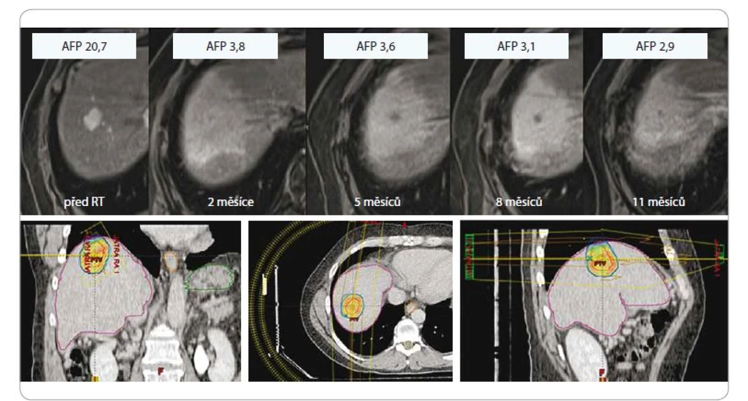 Hepatocelulární karcinom u 61letého pacienta po SBRT, dávka 3 × 18 Gy, předpis na 80% izodózu, efekt léčby (regrese,
pokles AFP, asymptomatická postradiační reakce v okolním jaterním parenchymu).<br>
SBRT – extrakraniální stereotaktická radioterapie, AFP – alpha-fetoprotein, Gy – Gray