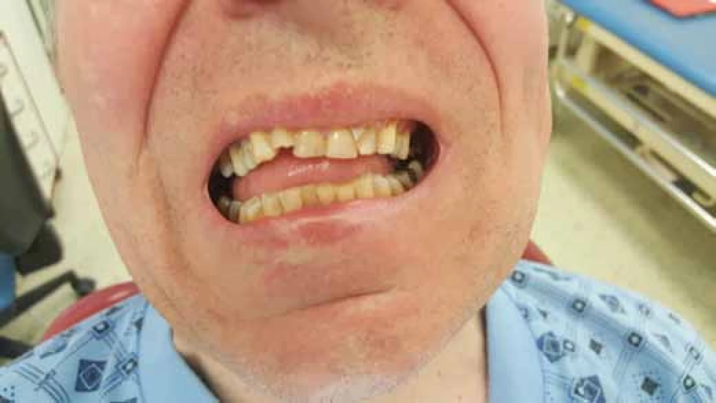 Patient with a fracture of articular recess of mandible and open bite 