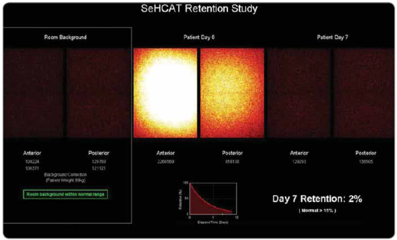 SeHCAT sken: malabsorpce žlučových kyselin prokázána (retence radiofarmaka v den 7: 2 %). Převzato se svolením
autorů [100].