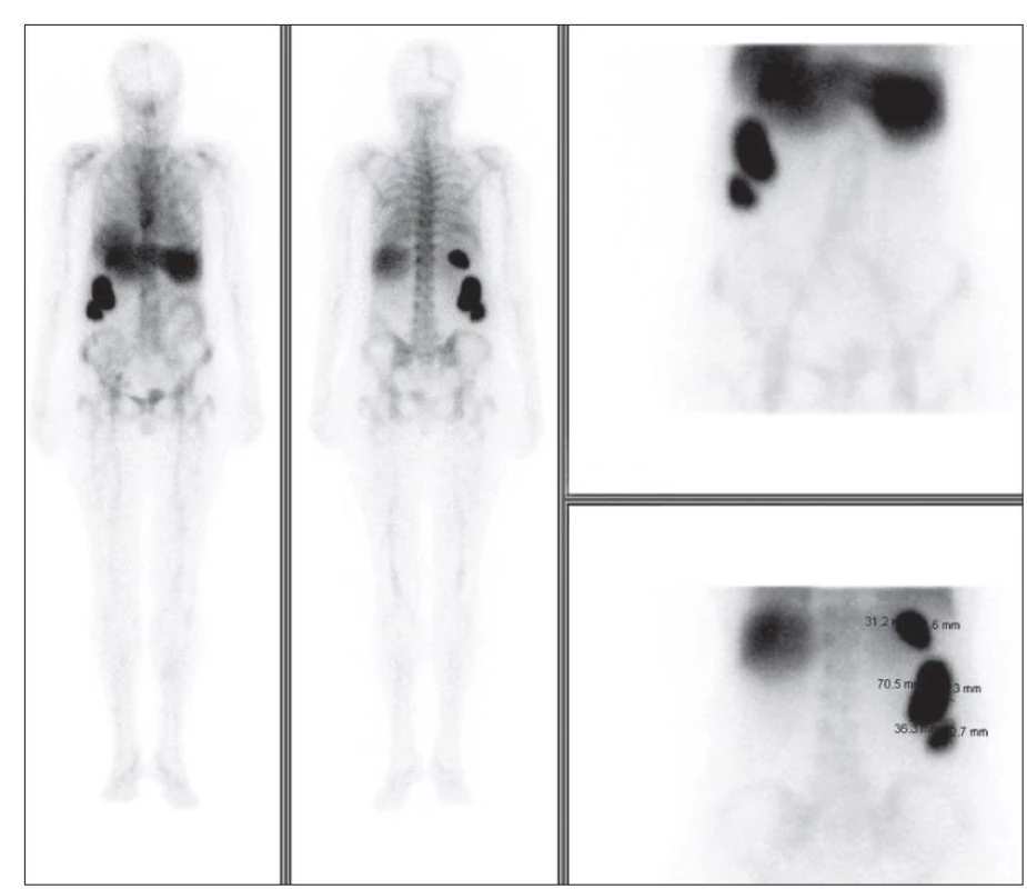 Scintigrafie značenými autologními leukocyty (WB a cílené obrazy břicha, nahoře pohled přední, dole pohled
zadní).).