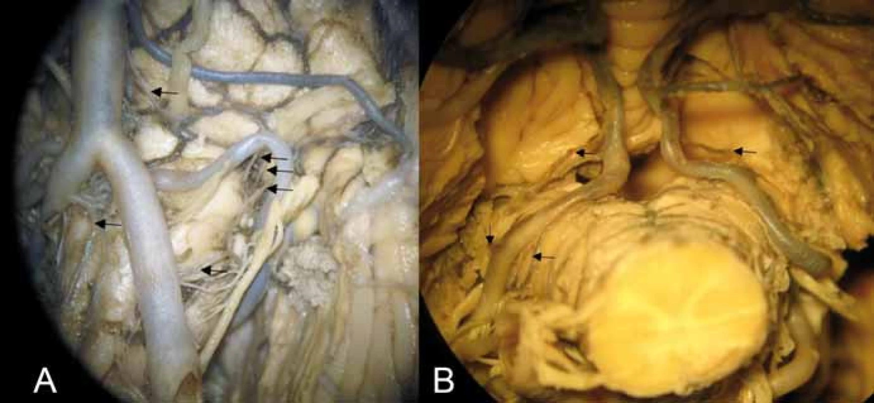 (A) Anteriorní a laterální perforátory pro medulla oblongata. Šipky označují
kaudokraniálně – laterální medullární perforátory z arteria vertebralis, arteria spinalis
anterior, laterální medullární perforátory z arteria cerebelli inferior posterior v oblasti
retroolivární fossy, pontomedullární arterie vstupující do sulcus bulbopontinus. (B)
Tonsillomedullární a telovelotonsillární segment arteria cerebelli inferior posterior;
kraniální šipky – rostrální zadní medullární arterie vč. choroidální větve (vlevo) a větévky
ke corpus restiforme; kaudální šipky vlevo – dorzální perforátory z arteria cerebelli
inferior posterior (ve skupině laterálních perforátorů).<br>
Fig. 3. (A) Anterior and lateral perforators of the medulla oblongata. Arrows showing
caudocranially lateral medullary perforators arising from the vertebral artery, anterior
spinal artery, lateral medullary perforators arising from the posterior inferior cerebellar
artery in the retroolivary fossa, and pontomedullary arteries entering the bulbopontine
sulcus. (B) Tonsillomedullary and telovelotonsillary segment of the posterior inferior
cerebellar artery; upper arrows showing the rostral dorsal medullary artery including
the choroidal branch (left) and small branches for corpus restiforme, and lower arrows
on the left showing dorsal perforators arising from the posterior inferior cerebellar
artery (in the group of lateral perforators).