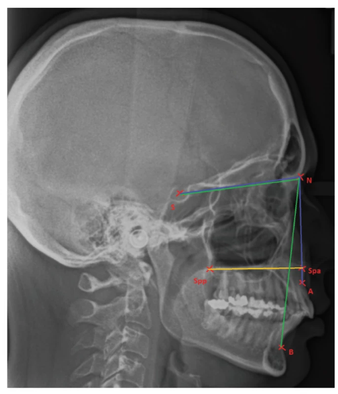 Position of jaws related to the cranial base and pointing out the maxillary corpus<br>
Point A: the most concave point of anterior maxilla;<br>
Point B: the most concave point on mandibular symphysis;<br>
N: nasion; S: the middle of sella turcica;<br>
Spp: the most posterior point on spina nasalis posterior;<br>
Spa: the most anterior point on spina nasalis anterior
