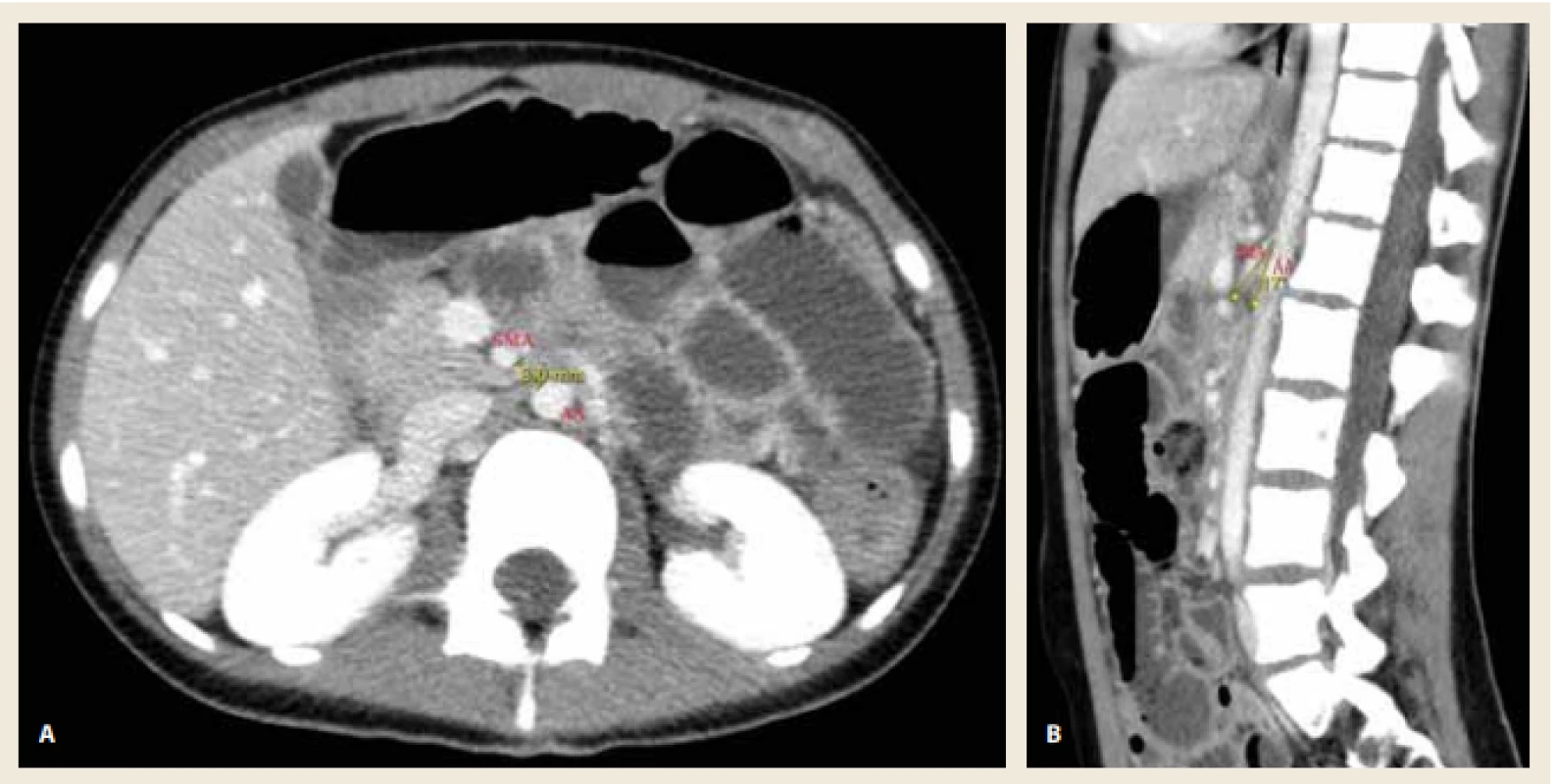 A. Kontrastní CT břicha (transverzální rovina) s patrným snížením aortomezenterické vzdálenosti na 8 mm.<br>
Obr. 2B. Kontrastní CT břicha (sagitální rovina) s patrným snížením aortomezenterického úhlu na 17°. <br>
Fig. 2A. Contrast-enhanced CT scan of abdomen (axial view) shows the reduction of aortomesenteric distance to 8 mm.
Fig. 2B. Contrast-enhanced CT scan of abdomen (sagittal view) shows the reduction of aortomesenteric angle to 17°. 