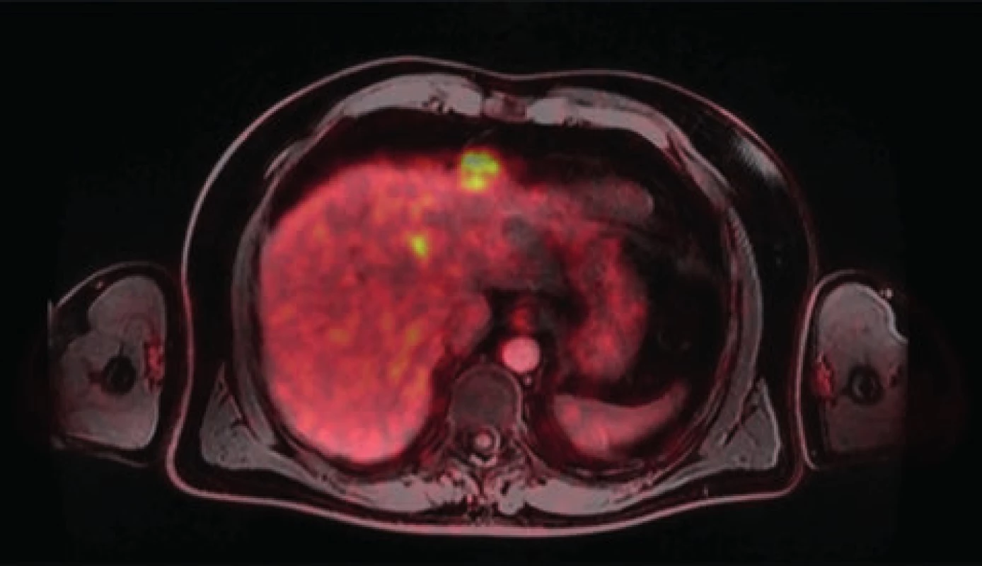 Vícečetné metastázy karcinomu rekta v játrech<br>
Fig. 1: Multiple liver metastases of rectal cancer