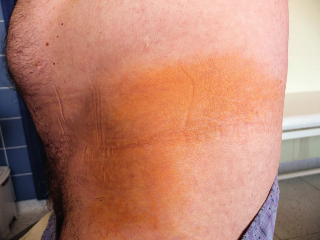 Žluté zbarvení kůže na trupu: podkladem této barevné morfy je
xantogranulom popsaného pacienta
