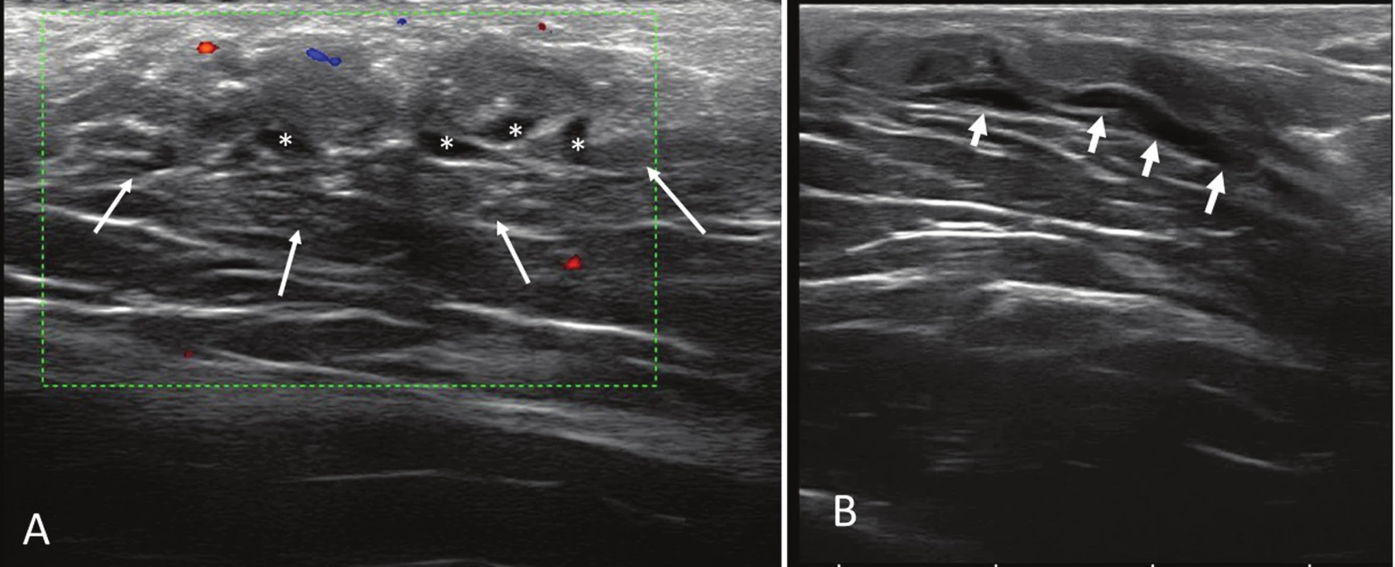 Sonography study. Axial (A) and longitudinal (B) sonograms of the lesion. Notice the anechoic tubular structures (*) and the poorly defined margins of
the mass (white arrows).