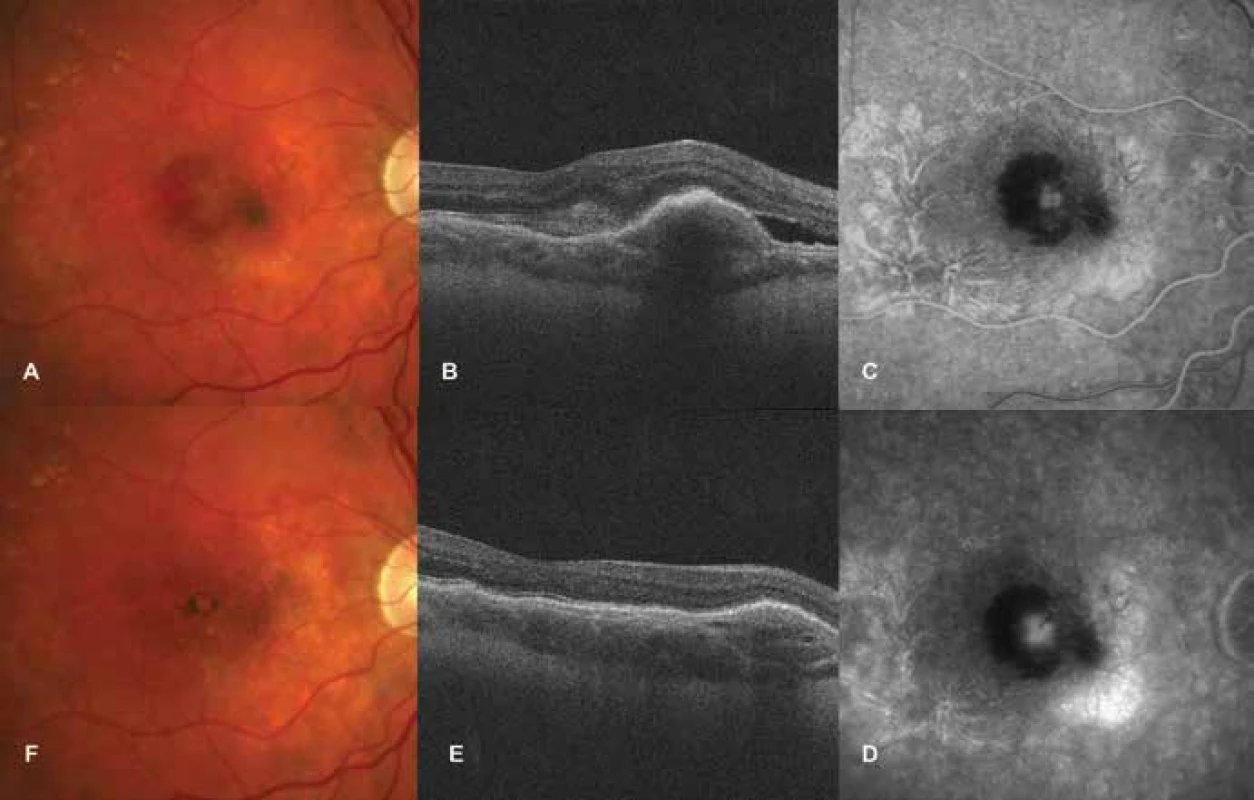 Idiopathic choroidal neovascularisation<br>
A. Photograph of fundus before commencement of treatment with ranibizumab. Lesion on neovascular membrane, subretinal
haemorrhages around lesion<br>
B. HD-OCT before treatment. Ablation and edema of neuroretina, elevation of retinal pigment epithelium.<br>
C-D. FAG finding at first visit. Progressively grading hyperfluorescence of neovascular membrane, blockade of fluorescence
due to subretinal haemorrhage<br>
E. HD-OCT after treatment. Reduction of edema of neuroretina and retinal pigment epithelium<br>
F. Photograph of fundus after treatment. Bordered lesion with pigment