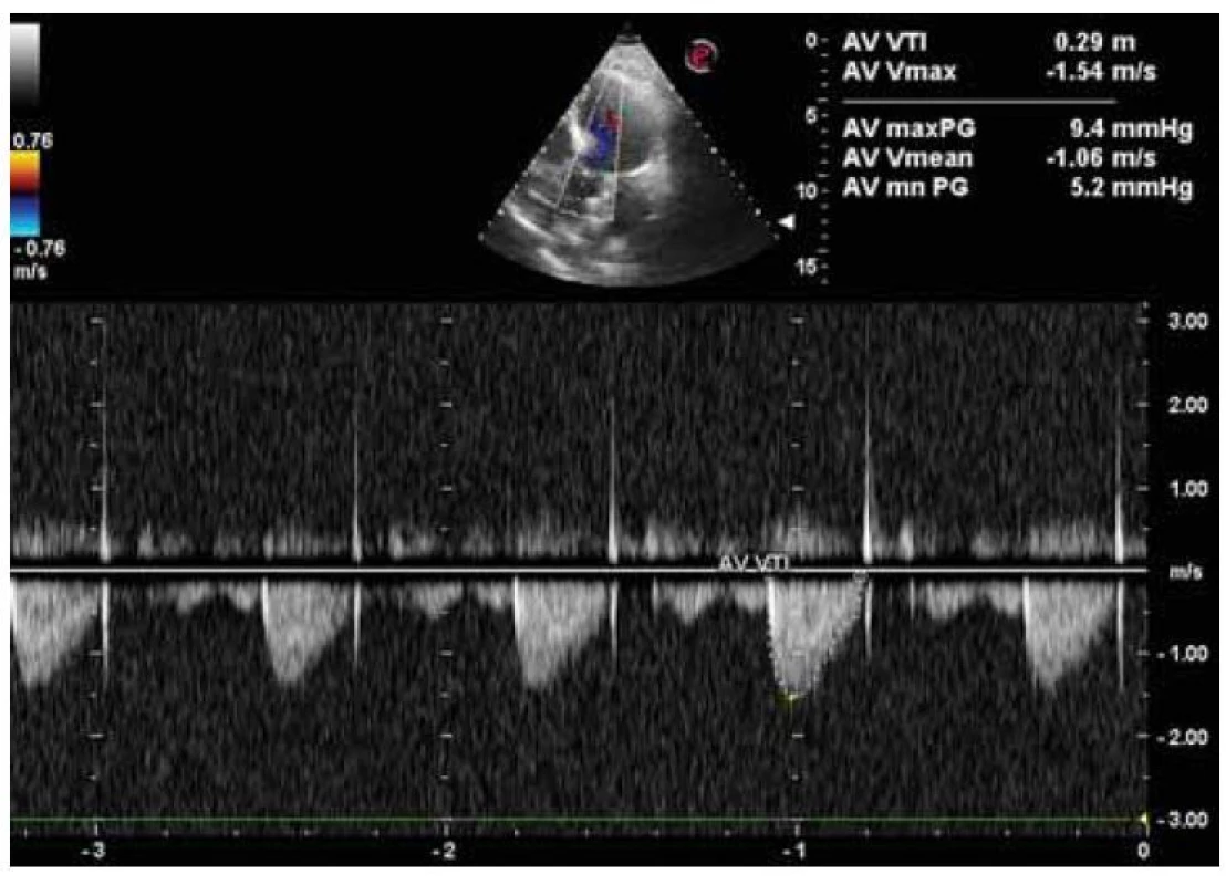 Echokardiografický nález aortálnej stenózy ľahkého stupňa (AVA
1,7 cm2) na podklade sklerodegeneratívnych zmien.<br>
Fig. 5. Echocardiographic finding of mild aortic stenosis (AVA 1,7 cm2) on the basis
of sclerodegenerative changes.