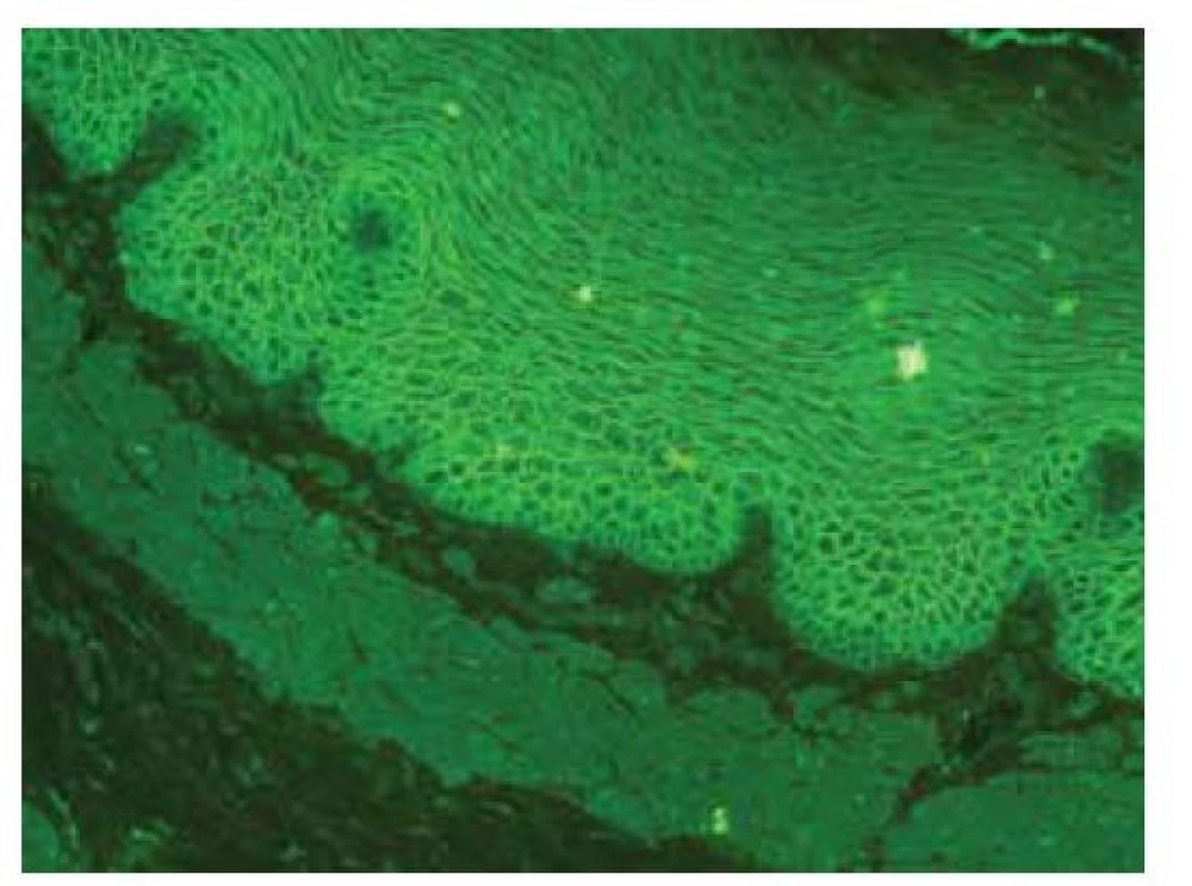 Nepřímá imunofluorescence – pozitivita ICS –
IgG protilátky u pemfigu, opičí ezofagus