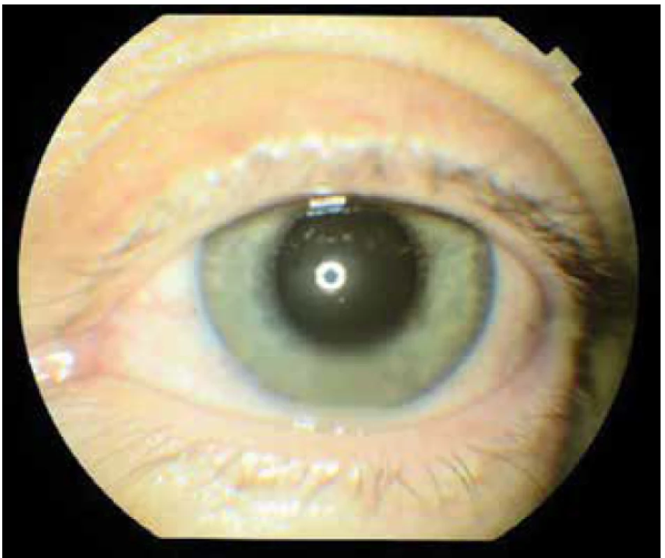 Ľavé oko pri 1.vyšetrení, hyperémia spojovky,
precipitáty na rohovke, tyndal v prednej komore, hypopyon,
hyperémia dúhovky