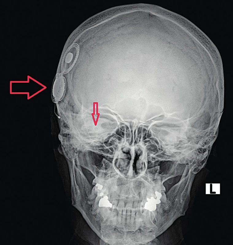 Nativní snímek hlavy – předozadní projekce, kochleární implantát pravostranný. Velkou vodorovnou šipkou
označeno tělo implantátu, malou svislou šipkou elektrodový
svazek.