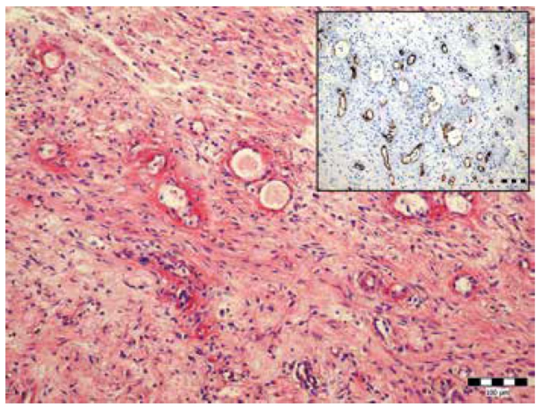 Fibrinoidná nekróza stien ciev malého kalibru v mezentériu. Farbenie
hematoxylín-eozín (zväčšenie 200x). Vložený obrázok imunohistochémia
anti CD-34 (zväčšenie 200x).