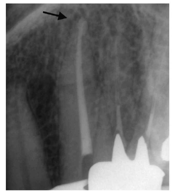 Kontrolní RTG snímek po plnění <br>
Fig. 10 Control X-ray after root canal filling