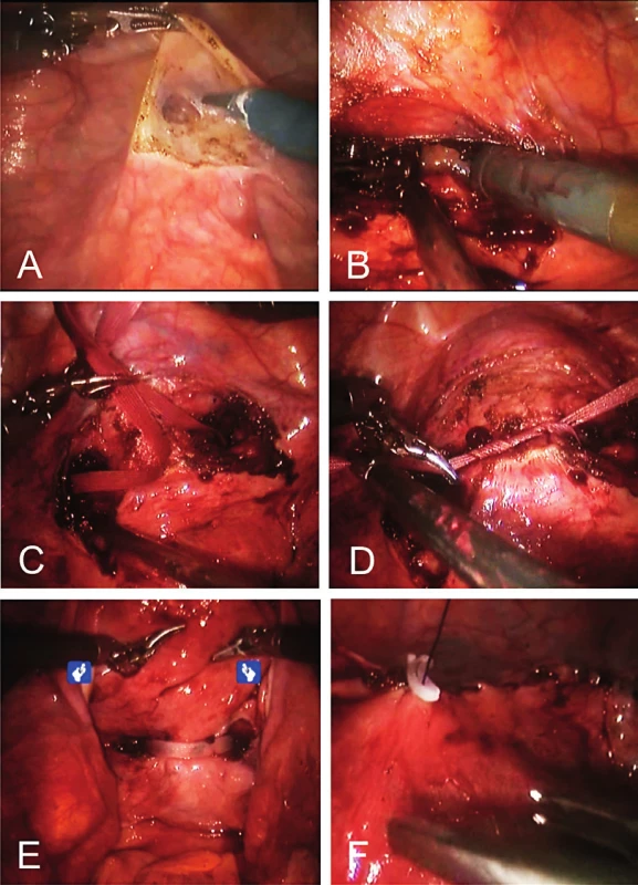 Robotic-assisted abdominal cerclage; (A) preparation
of the vesicouterine excavation, (B) dissection of the avascular
window, (C) passing of the suture, (D) tying of the mersilene tape,
(E) posterior aspect of the tape, (F) placement of a hemolock clip.