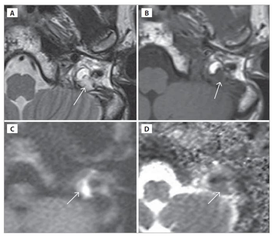 MR spánkových kostí.<br>
a) T2-vážený obraz, b) T1-vážený obraz, c) DWI (HASTE), d) ADC mapa; päť mesiacov
po 5. revíznej operácii. Cholesteatóm nasadajúci na sinus sigmoideus (šípka).<br>
Fig. 4. MRI of the temporal bones.<br>
a) T2-weighted image, b) T1-weighted image, c) DWI (HASTE), d) ADC map; fi ve
months after the 5th revision operation. Cholesteatoma attaching to the sigmoid
sinus (arrow).