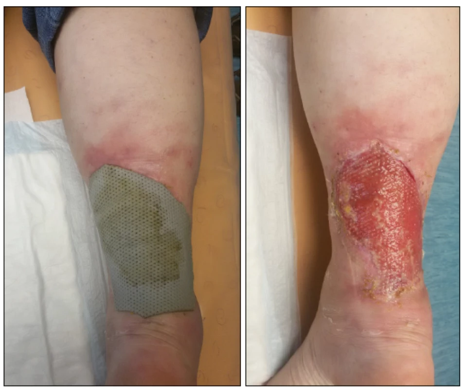 , 8.: Situation after 3 weeks of outpatient changes of dressings,
using Betadine Ointment and Mepilex® Ag