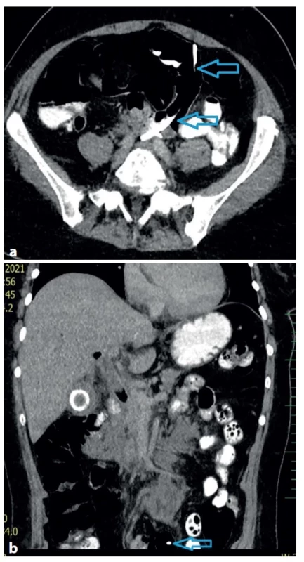 (a−b) CT – drén vycestovaný z dc. choledochus do
tenkého střeva (modrá šipka)<br>
Fig. 4 (a−b) CT scan – the drain, moved from the common
bile duct into the small bowel (blue arrow)