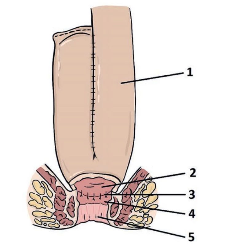Topografie ileálního pouche.<br>
1) aferentní klička tenkého střeva; 2) apex ileálního pouche; 3) ileo-rektální
anatomóza; 4) Rektální manžeta (zbytek původního rekta); 5) anus.
